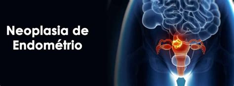 cid 10 neoplasia endometrio